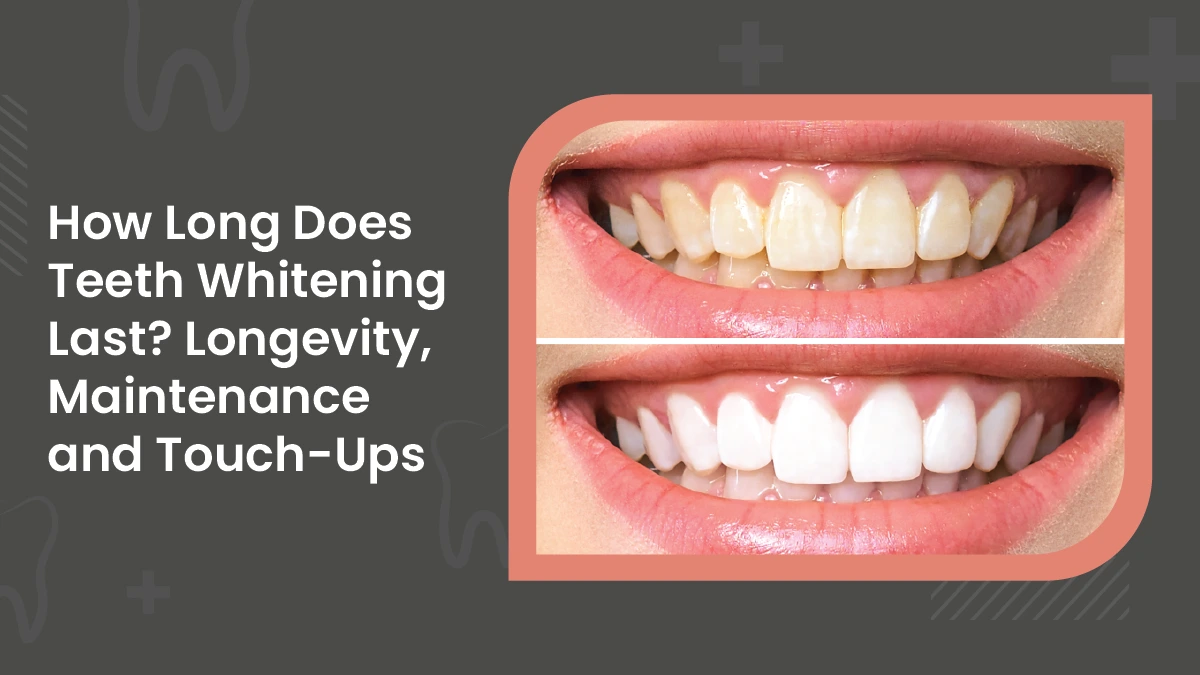 How long does teeth whitening last? Longevity, Maintenance and Touch-Ups
